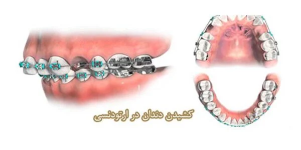 در ارتودنسی کدام دندان را میکشند؟