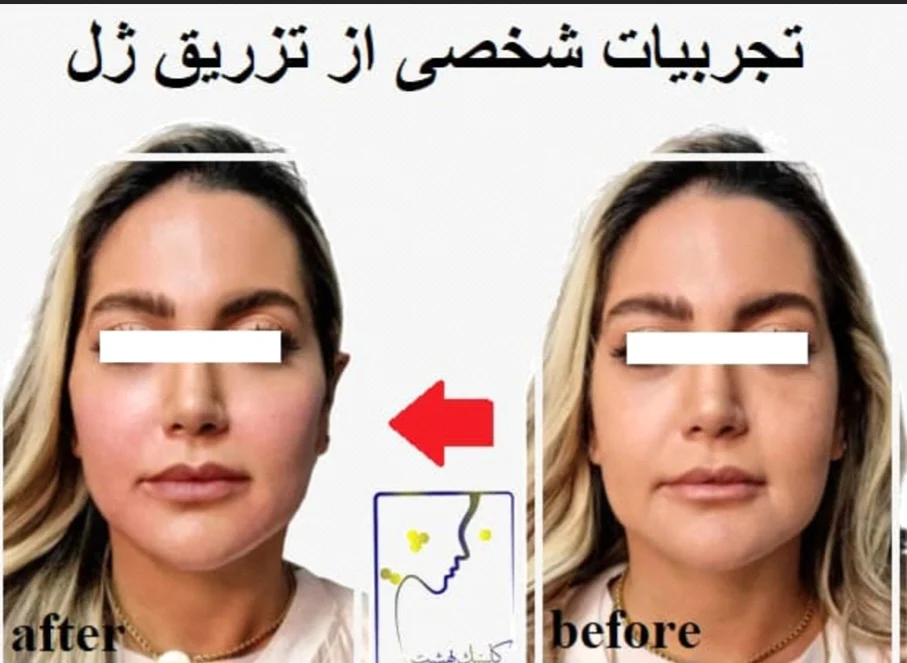 تجربیات شخصی از تزریق ژل