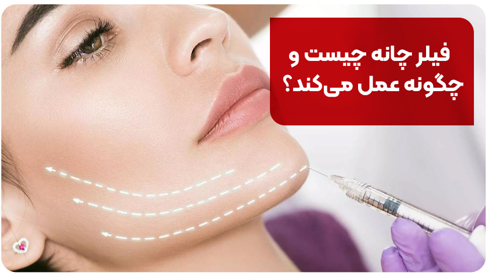 فیلر چانه چیست و چگونه عمل می‌کند؟