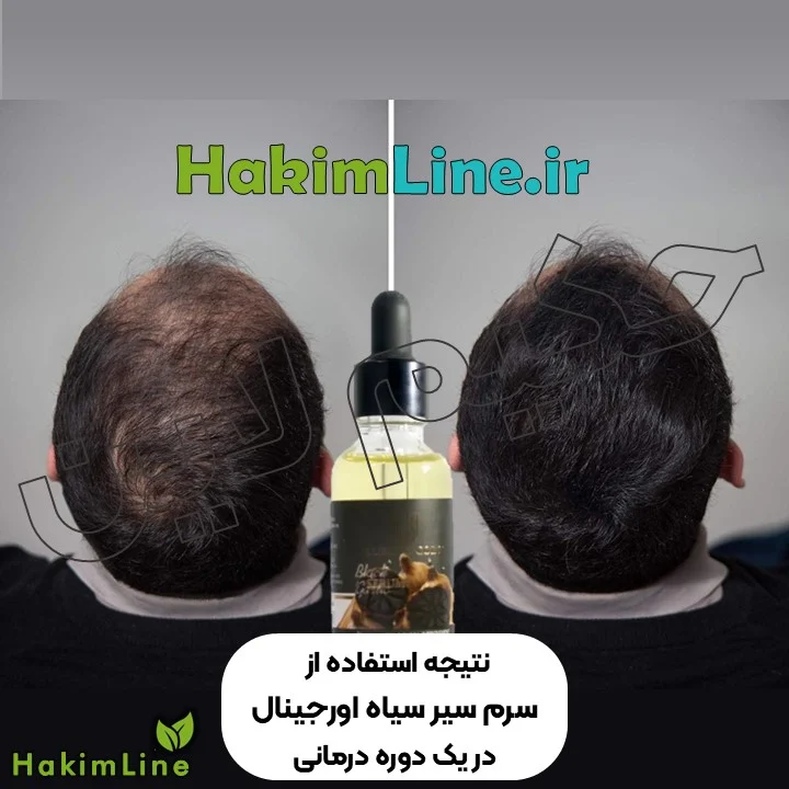آیا سرم سیر سیاه برای مو خوب است