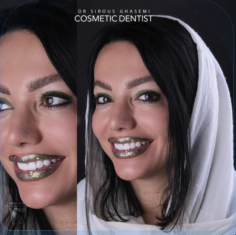 تجربه زیبایی و راحتی دندان هایتان با لمینت دندان در مطب دکتر قاسمی داشته باشید