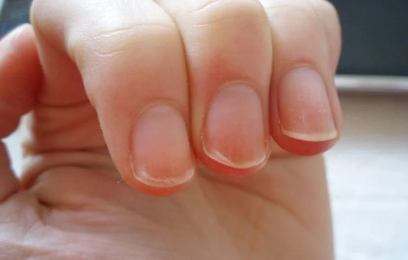 علت پوسته پوسته شدن ناخن چیست؟ + روش ترمیم